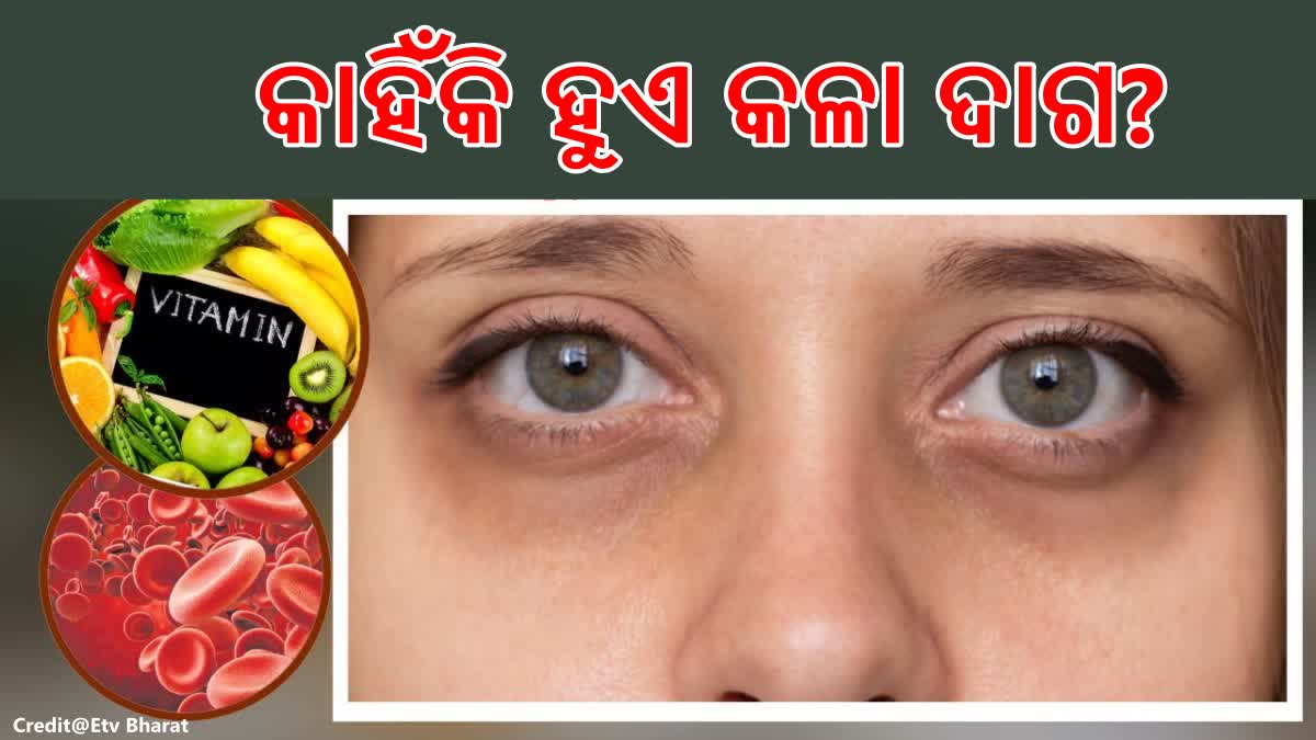 ଆଖି ତଳେ କଳାଦାଗ ନେଇ ଚିନ୍ତିତ କି? ଏହି ଜିନିଷ ପ୍ରତି ଧ୍ୟାନ ଦିଅନ୍ତୁ