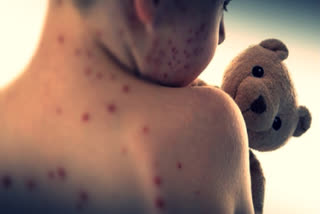 Global measles cases see 88pc jump in 2023 from 2022: WHO