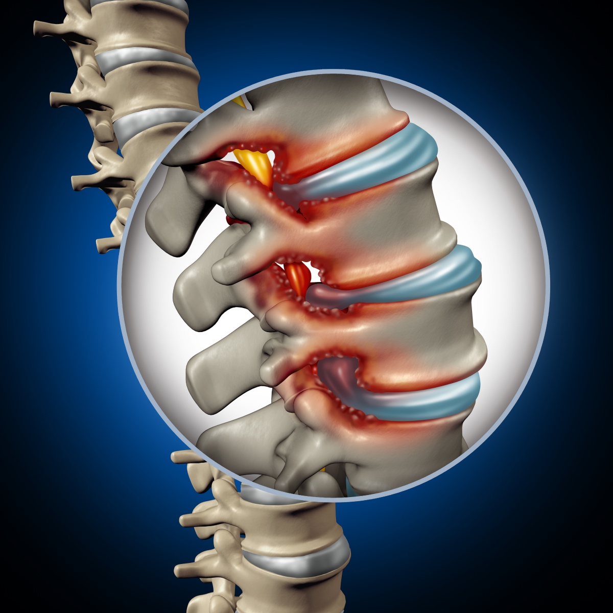 BACK PAIN COMMON CAUSES BACK PAIN TREATMENT BACK PAIN ಬೆನ್ನು ನೋವು