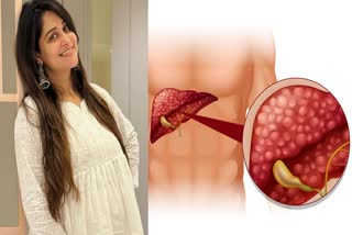 Actress Dipika Kakkar diagnosed with stage two liver cancer let's know about it