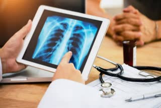 Lung Cancer Detection By AI : ઉચ્ચ સચોટતા સાથે ફેફસાના કેન્સરની તપાસ માટે AIનું પરિણામ ઘણું સારું : અભ્યાસ