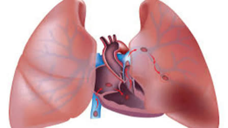 വായു മലിനീകരണം  AIR POLLUTION DURING CHILDHOOD  AIR POLLUTION AFFECT LUNG HEALTH  ശ്വാസകോശ ആരോഗ്യം