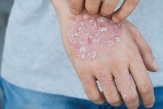 PSORIASIS TREATMENT AND PREVENTION  HOW TO MANAGE SKIN CONDITION  SKIN INFECTION TREATMENT  ചര്‍മ്മ രോഗം സോറിയാസിസ്