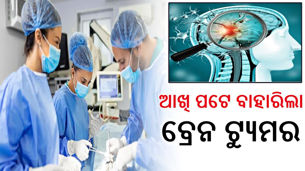 ବିରଳ ଅସ୍ତ୍ରୋପଚାର ! ଆଖି ପଟେ ବ୍ରେନ ଟ୍ୟୁମର ବାହାର କଲେ ଡାକ୍ତର