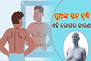 ପୁଅଙ୍କୁ ଗାଇନାକୋମାଷ୍ଟିଆ ବିପଦ; ଜାଣନ୍ତୁ କ'ଣ ଏହି ରୋଗ, କେମିତି ହୁଏ ଚିକିତ୍ସା ?