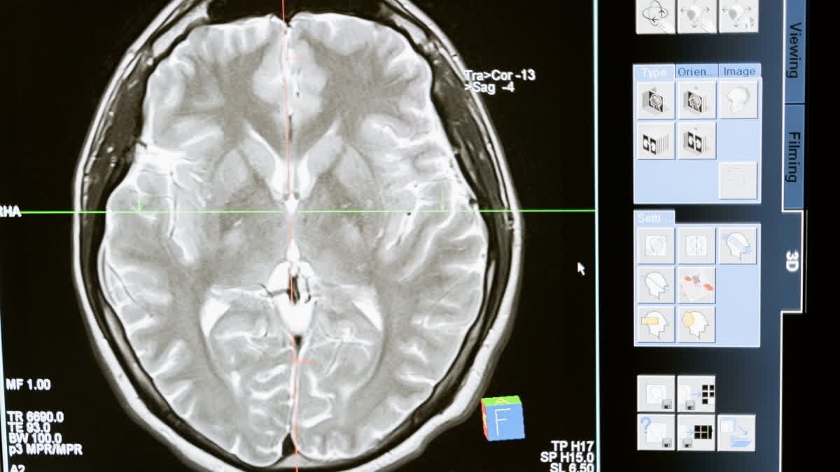 People with obsessive-compulsive disorder have an imbalance of brain chemicals - our discovery could mean a treatment breakthrough