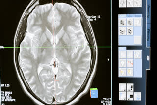 People with obsessive-compulsive disorder have an imbalance of brain chemicals - our discovery could mean a treatment breakthrough