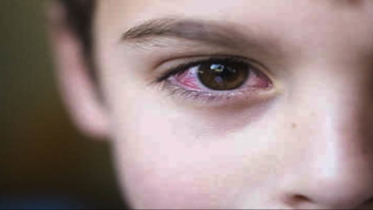 Eye Diseases In Nashik