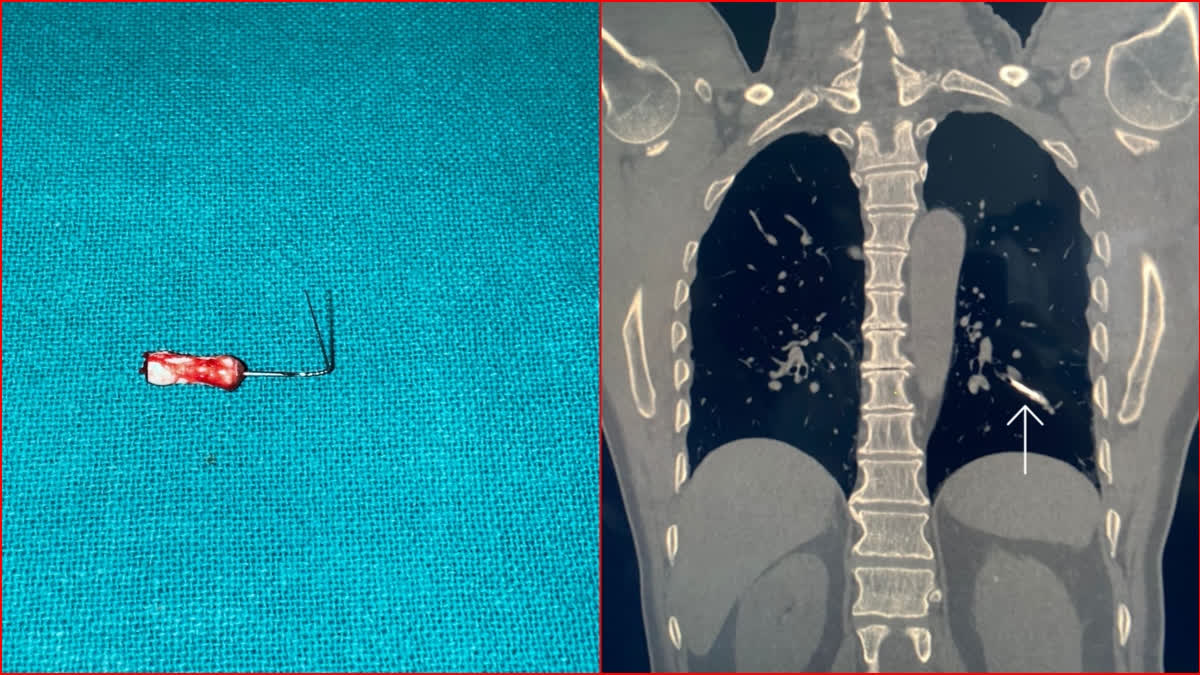 After four hours of complicated and risky surgery, doctors of Pandit Bhagwat Dayal Sharma Post Graduate Institute of Medical Sciences (PGIMS) in Haryana's Rohtak were successful in taking out a needle stuck in the lungs of a patient.