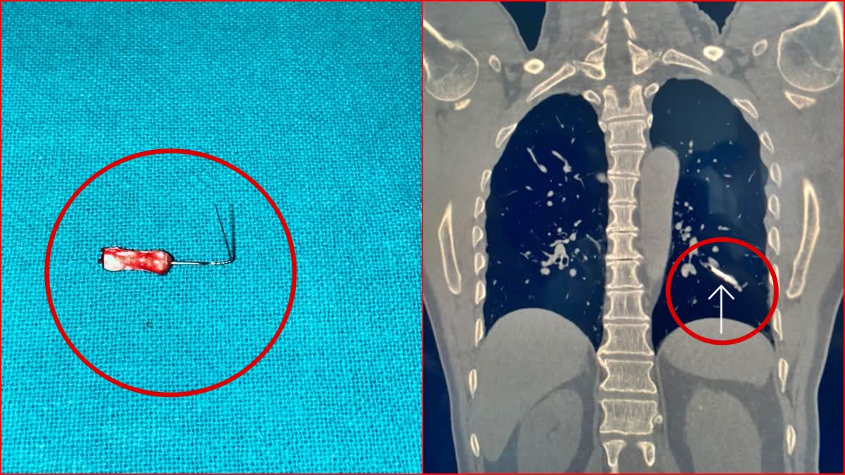 Rohtak PGIMS Operation  Haryana Rohtak PGI  PGI Rohtak Doctors Major Operation  Pin stuck in man lung removed  ಶ್ವಾಸಕೋಶದಲ್ಲಿ ಸಿಲುಕಿಕೊಂಡಿದ್ದ ಗುಂಡು ಸೂಜಿ  ವೈದ್ಯರ ಪರಿಶ್ರಮದಿಂದ ಬದುಕುಳಿತು ಬಡ ಜೀವ  ಶ್ವಾಸಕೋಶದಲ್ಲಿ ಸಿಲುಕಿಕೊಂಡಿದ್ದ 2 ಇಂಚಿನ ಗುಂಡು ಸೂಜಿ  X RAY ನಲ್ಲಿ ಕಾಣಿಸದ ಗುಂಡು ಸೂಜಿ  ಶ್ವಾಸನಾಳದಲ್ಲಿ ಗುಂಡು ಸೂಜಿ ಸಿಲುಕಿಕೊಂಡಿದ್ದು ಹೇಗೆ  ರೋಗಿ ಸುರಕ್ಷಿತ  ವೈದ್ಯೋ ನಾರಾಯಣ ಹರಿ