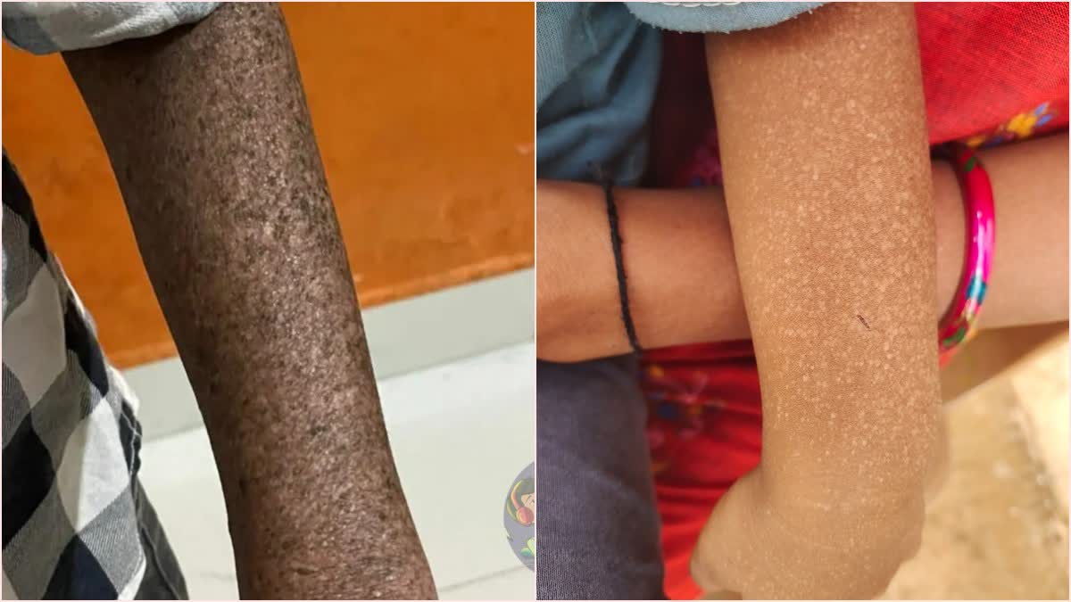 collector-meets-children-with-strange-skin-disease-in-chamarajanagara