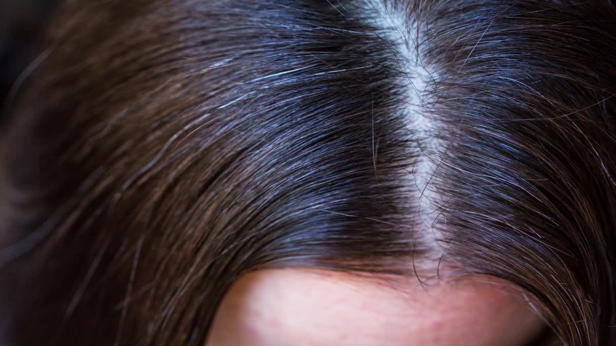 Hair Dandruff News