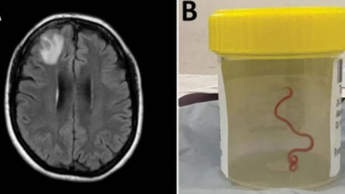 Doctor find  8cm long warm in Australian women brain