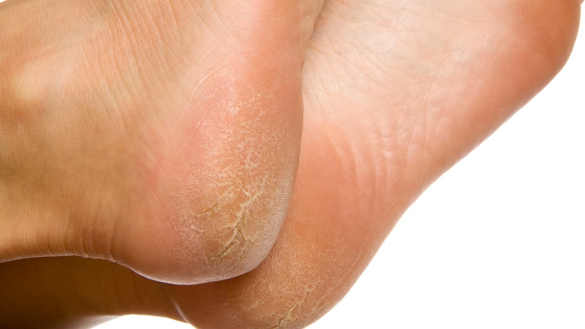 Now say goodbye to cracked heels, make your feet soft with these home remedies