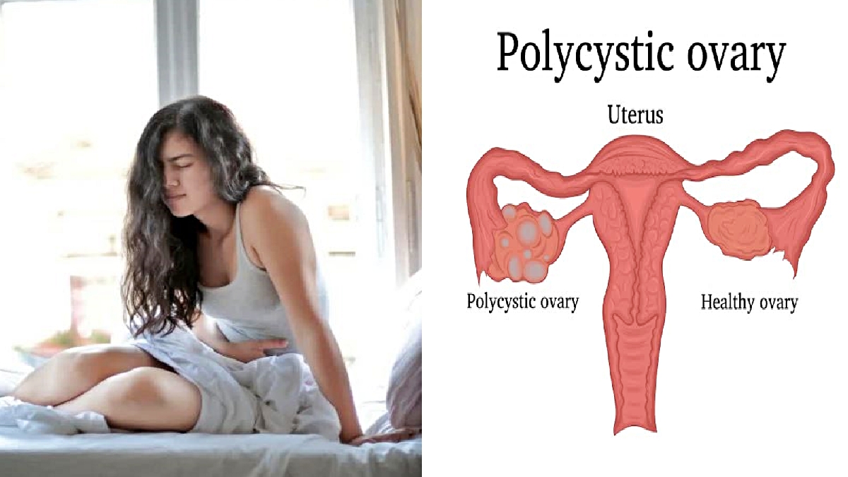 Polycystic ovarian syndrome symptoms cure tips and PCO Syndrome