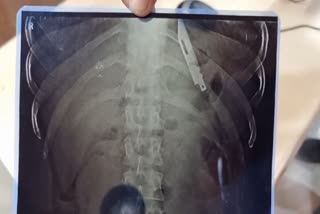 knife in young man's stomach