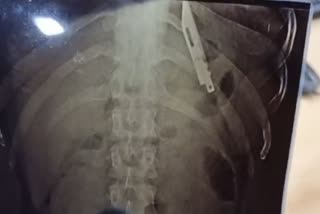 Knife Found in Gujrat Mans Stomach