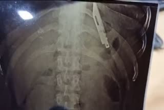 gujarat  knife in stomach  knife found in gujarat mans stomach  five years with a knife in the stomach  വയറ്റില്‍ കത്തി കണ്ടെത്തി  in Xray and found a knife in his stomach  knife lodged in stomach  discover knife inside stomach  എക്‌സ്‌റേ എടുത്തപ്പോള്‍ വയറ്റിൽ കത്തി കണ്ടെത്തി  വയറിനുള്ളിൽ കത്തി കണ്ടെത്തി  Knife Found In Stomach