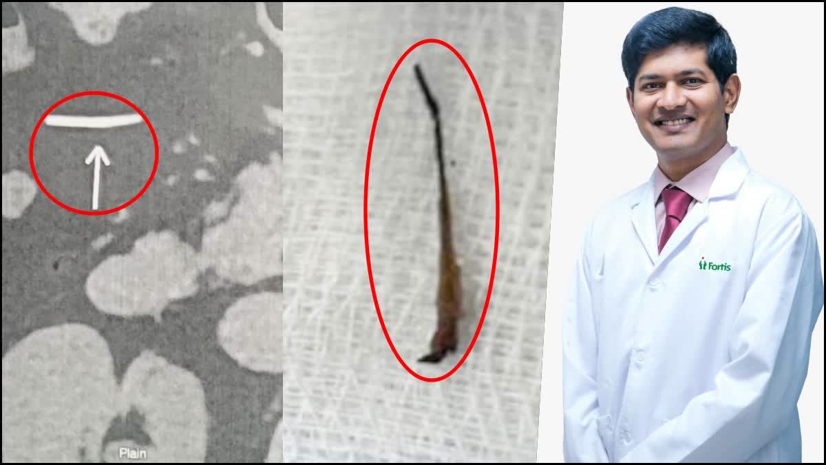 The endoscopic images of the fishbone and (right) Dr Pranav Honnavara Srinivasan