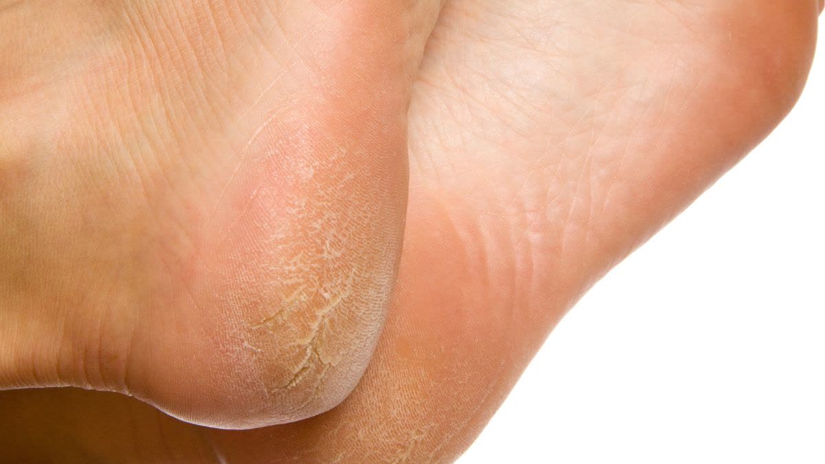 Home Remedies For Cracked Heels