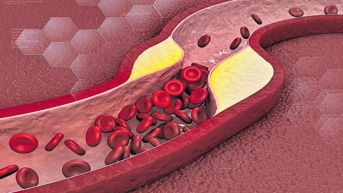 with-out-consulting-doctor-ldl-patients-stopping-statins