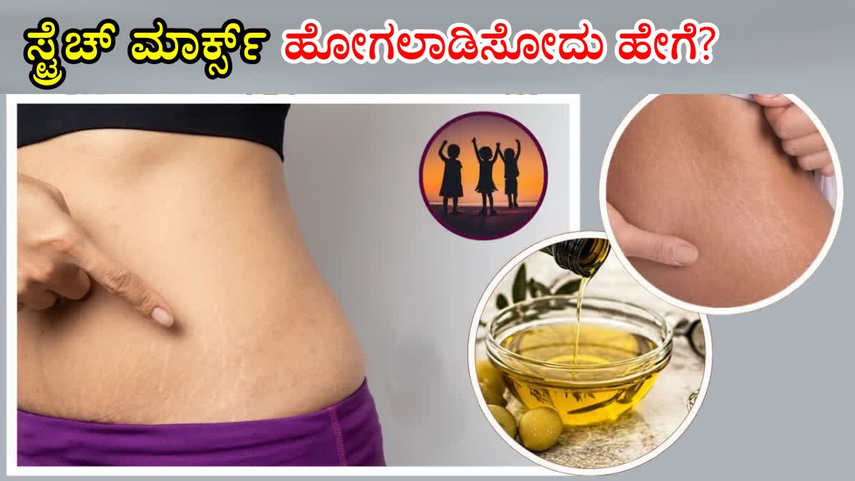 REDUCE STRETCH MARKS IN CHILDREN  TIPS FOR REMOVE STRETCH MARKS  CAUSES FOR STRETCH MARKS IN CHILD  REASONS FOR STRETCH MARKS IN CHILD