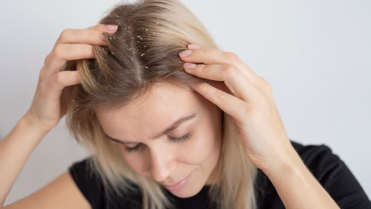 Dandruff in Winter: Causes, Symptoms, and Natural Treatments