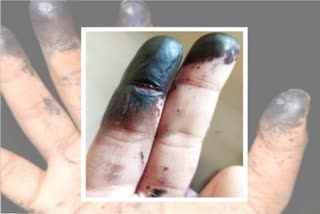 STUDENT TO APPLY INK  LOK SABHA ELECTION 2024  KOZHIKODE  STUDENT FINGER BURNED