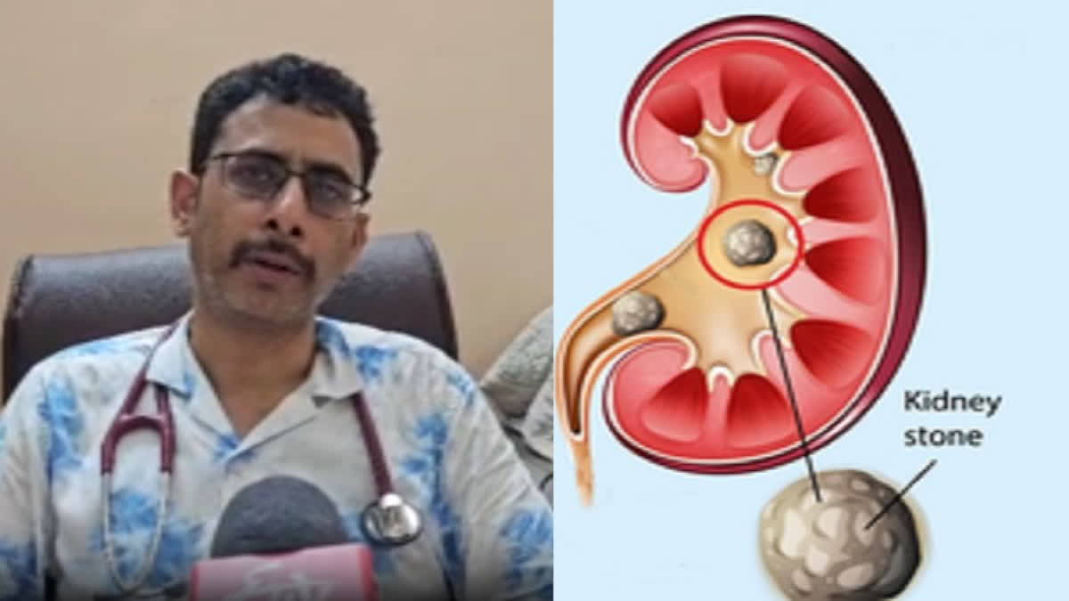 Kidney stone due to heatwave