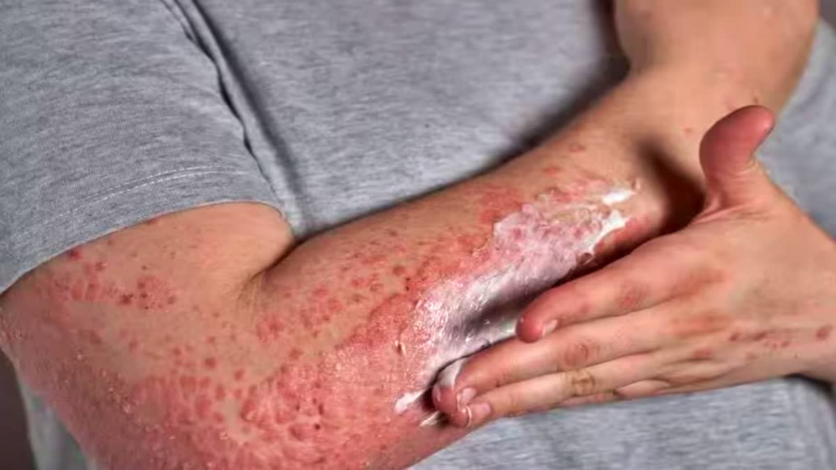 eczema