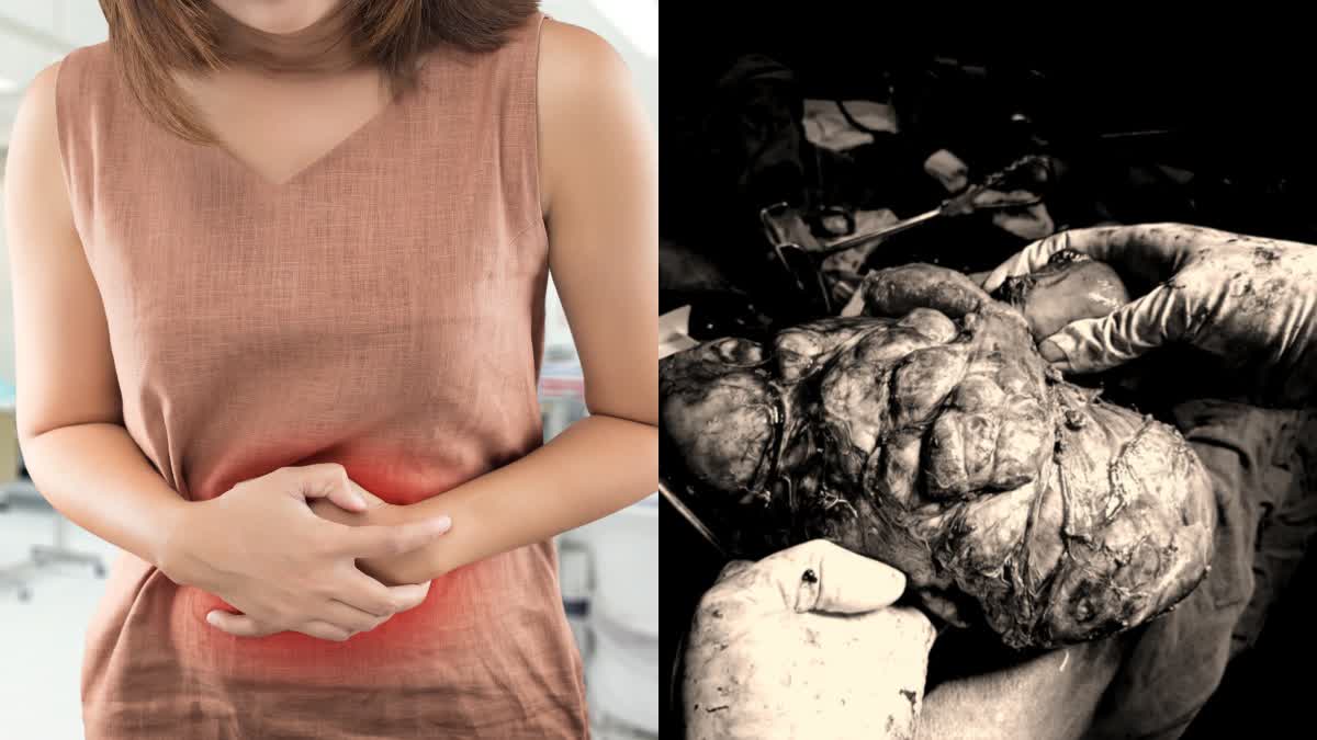 INDORE WOMEN STOMACH TUMOR