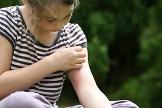 Natural Remedies Mosquito Bite News