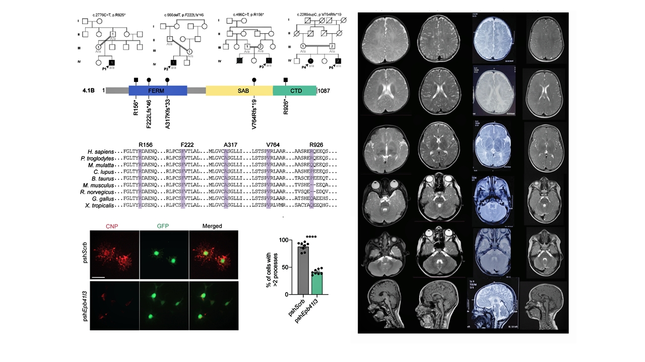 New genetic disorder  new research  brain disease  Udupi