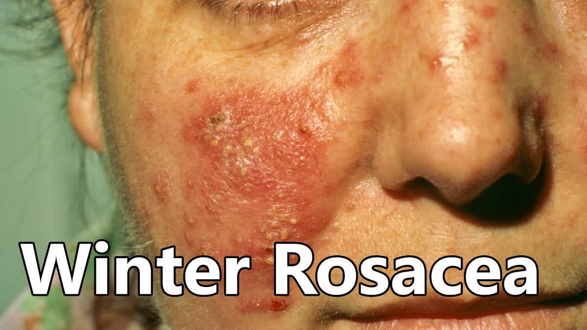 Winter Rosacea