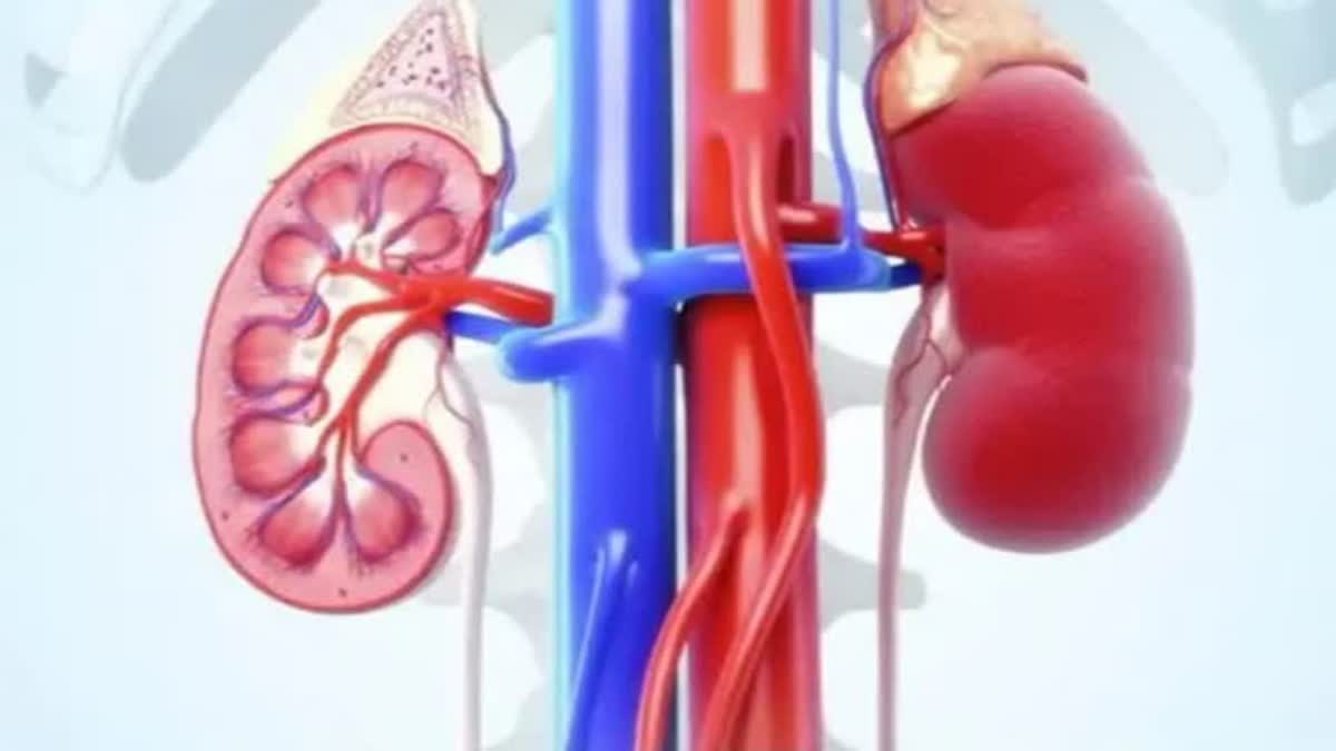 MP kidney transplant cases