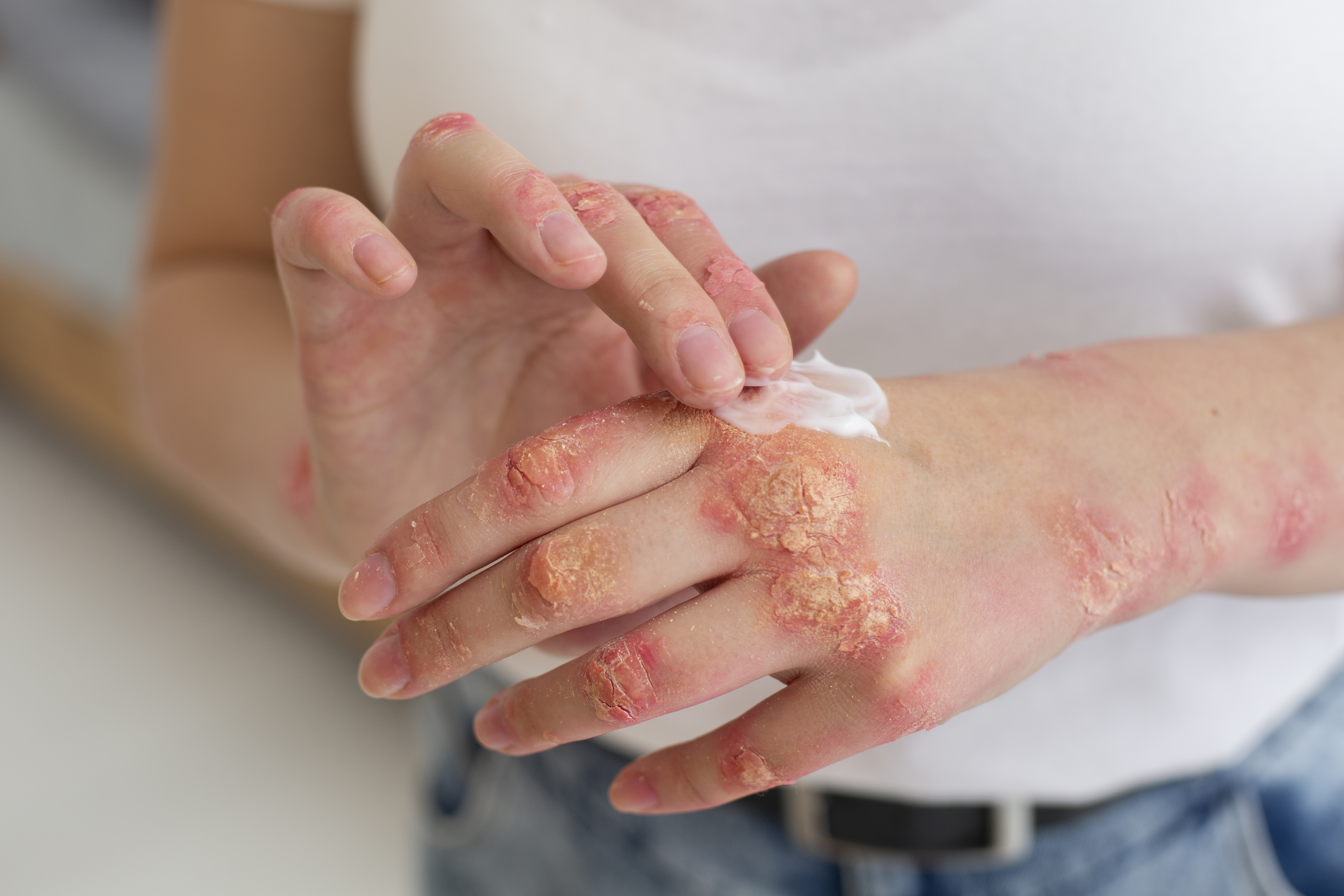 Patients suffering from Eczema or atopic dermatitis should keep distance from milk, curd, eggs, paneer and wheat bread