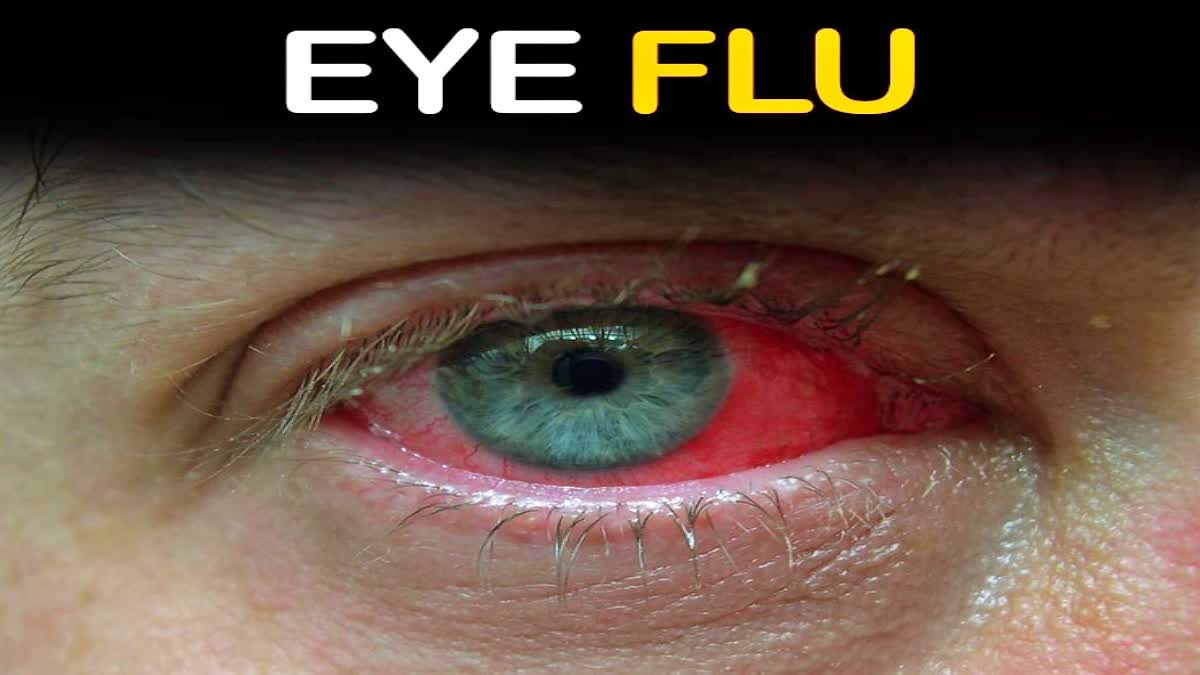 eye flu in una