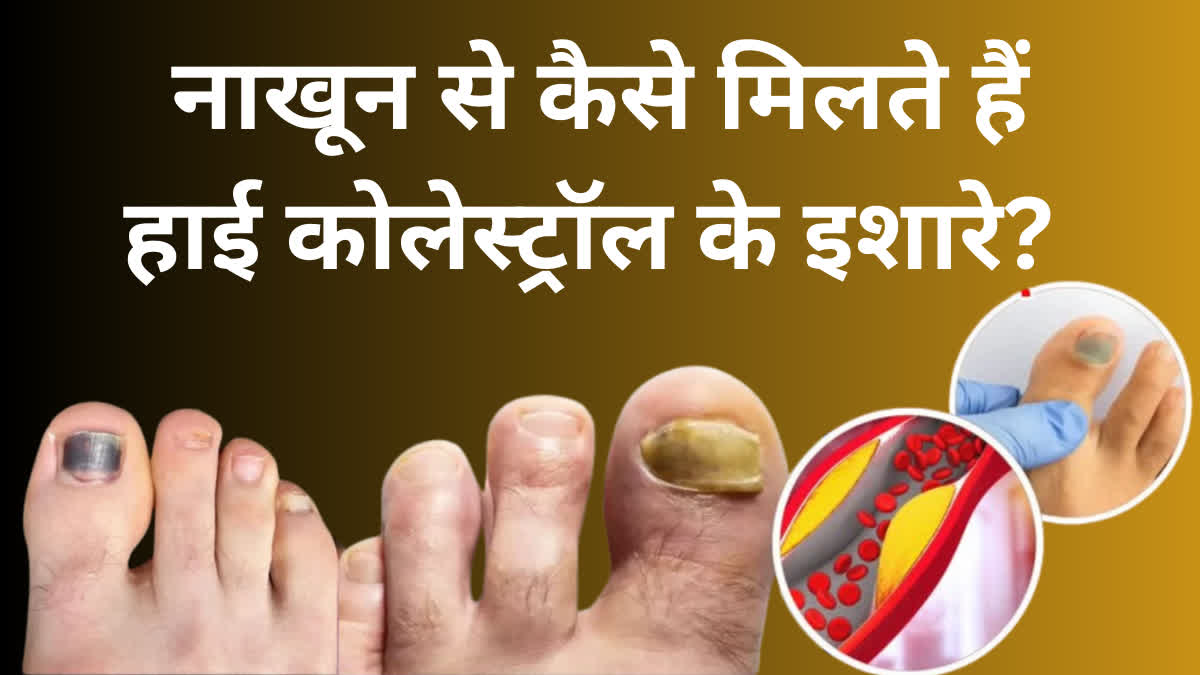 These signs of high cholesterol are seen in the nails of the feet, so don't make the mistake of ignoring them