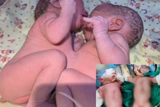 Conjoined twins separated successfully in  Wadia hospital of Mumbai