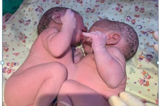 Conjoined twifdn sisters separated in rare surgery at Mumbai hospital