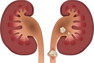 Ayurvedic treatment of kidney stone