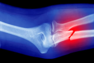 TYPES OF FRACTURE, bone weakness, health