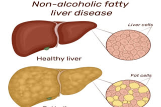 fatty liver, CVD, diabetes