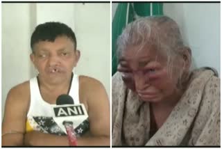 Bengal: BJP alleges party worker's mother thrashed, police say her face swollen due to ailment