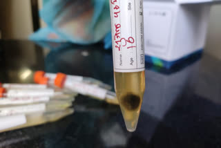 Fungi found in 110 samples of RTPCR at washim