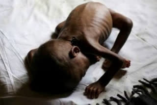 malnutrition in state