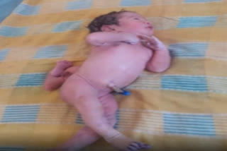 baby-born-with-three-legs-at-nuzivedu