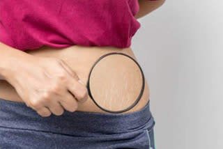 If you do this eat stretch marks remove