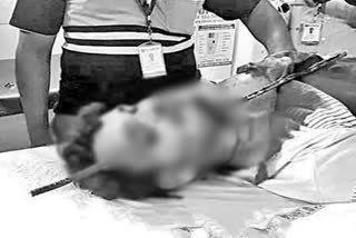 Accidently iron rod pierced, Accidently iron rod pierced through Young man neck, Visakhapatnam news, Visakhapatnam latest news, ಕತ್ತಿನಿಂದ ಮುಖದೊಳಗೆ ಹಾರುಪಾರಾದ ಕಬ್ಬಿಣದ ರಾಡ್, ವಿಶಾಖಪಟ್ಟಣದಲ್ಲಿ ಕತ್ತಿನಿಂದ ಮುಖದೊಳಗೆ ಹಾರುಪಾರಾದ ಕಬ್ಬಿಣದ ರಾಡ್, ವಿಶಾಖಪಟ್ಟಣ ಸುದ್ದಿ,