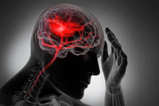 Higher than expected stroke risk in COVID-19 patients  risk of stroke  covid patients have a higher risk of stroke  American Stroke Association  അമേരിക്കൻ സ്ട്രോക്ക് അസോസിയേഷൻ  കൊവിഡ് രോഗികളിൽ സ്‌ട്രോക്കിന് സാധ്യത  സ്‌ട്രോക്കിന് സാധ്യത കൂടുതലെന്ന് പഠനം